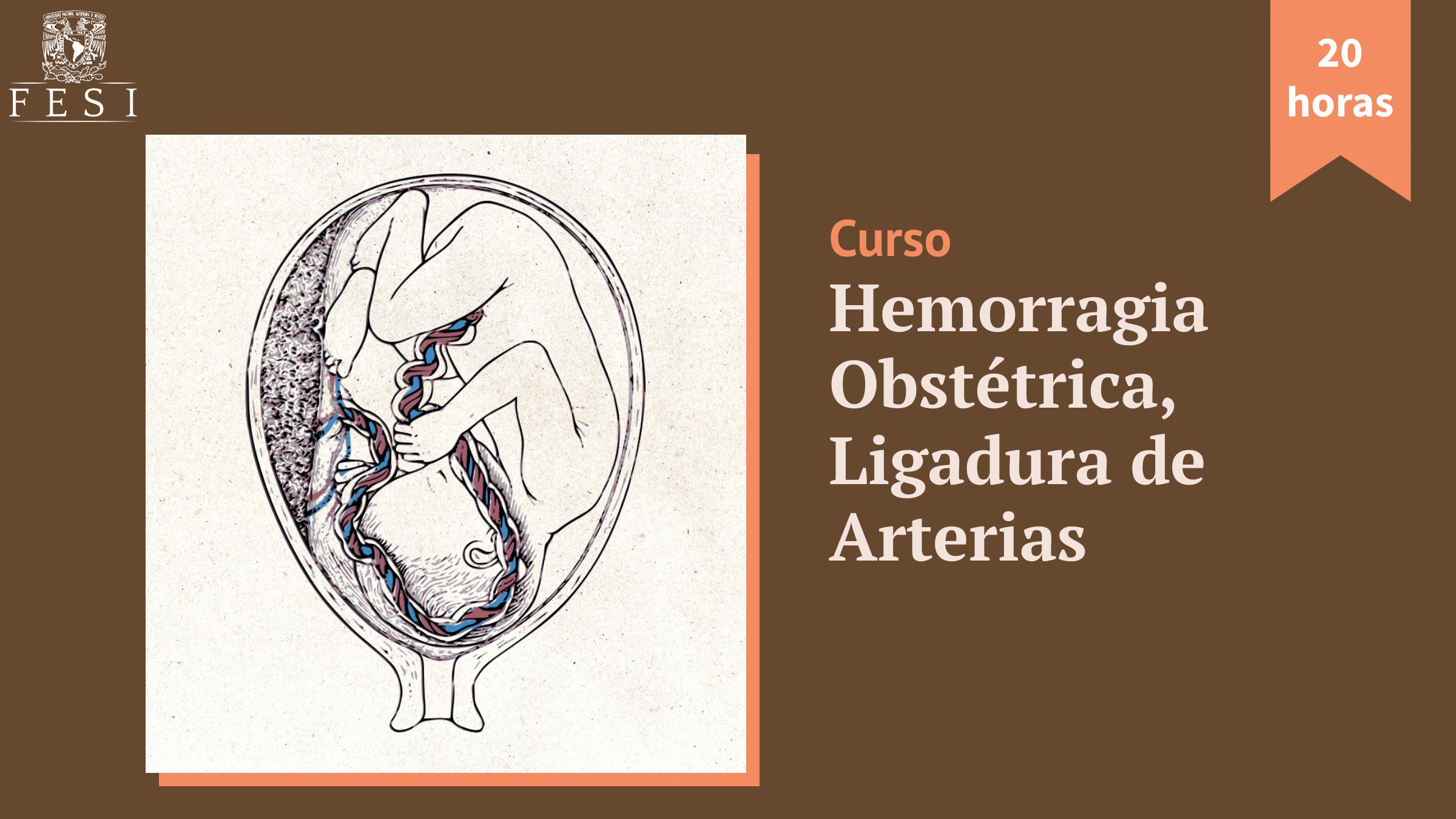 CC24223-Hemorragia Obstétrica, Ligadura de Arterias